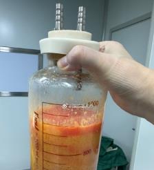 滁州水动力吸脂手术要做多久？